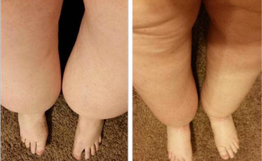 Marlene Simpson's legs before surgery (left) and one month after.