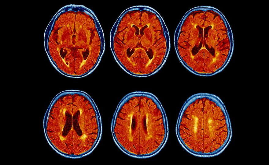 A colored magnetic resonance imaging (MRI) scans of the brain of a 76-year-old patient with dementia shows the brain has atrophied and the dark brown fluid-filled spaces have become enlarged.