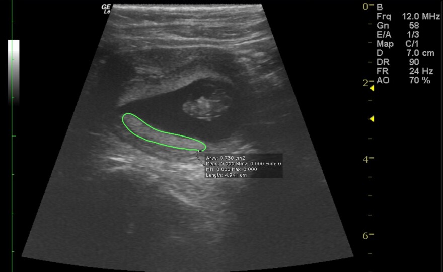 An ultrasound of a rhesus macaque fetus in the first trimester, just before researchers infected the mother with Zika virus.