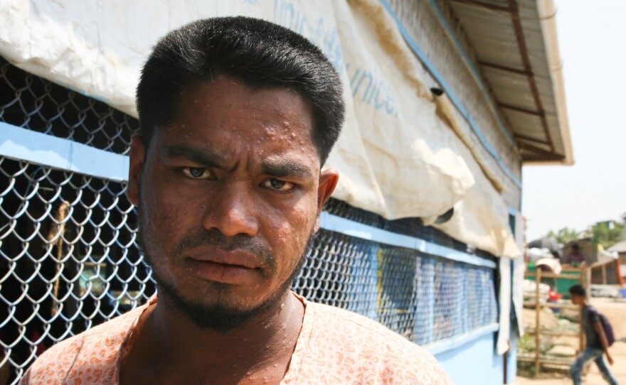 Sodul Amin, 30, is one of tens of thousands of Rohingya refugees who've gotten chickenpox since December. The highly contagious disease spreads easily in the overcrowded refugee camps.