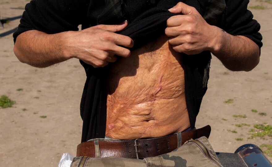 Hatem al-Hamad, 28, from Aleppo, Syria, and staying in Serbia's Krnjaca asylum center, shows his scars. He says the main injury came from a bomb blast in the Syrian war. Additional scars are from surgery he underwent in Belgrade in February. He says Hungarian police assaulted him on the country's border with Croatia. Hungarian officials have denied allegations of abuse.