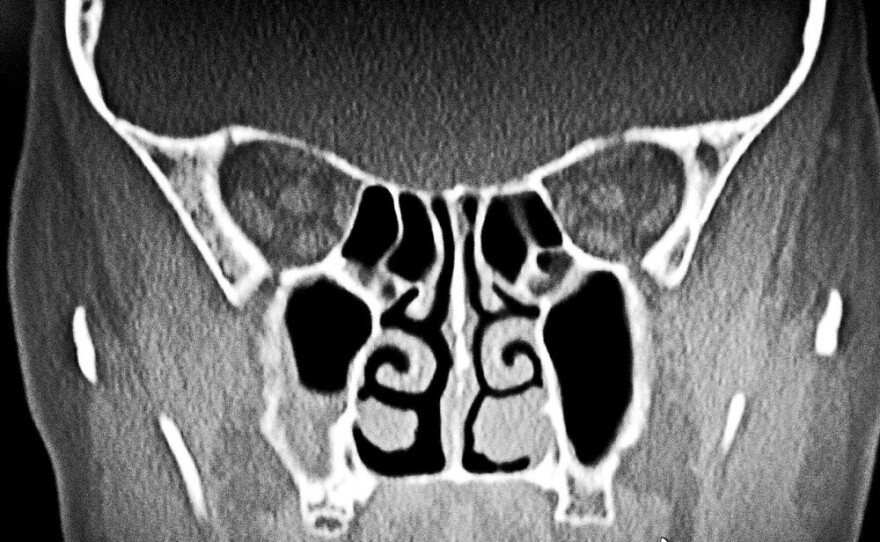 A CAT scan of patient Judy Foreman's sinuses shows obstructed sinus and nasal passages on the right side (her left) prior to sinus surgery.