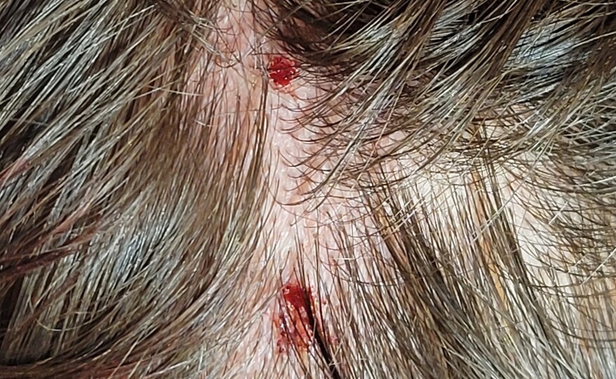 The scalp injuries that Kirsten Mathisen received from an aggressive barred owl.