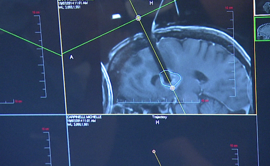 Scans show Chen is right on target, smack tab in the brain tumor. 