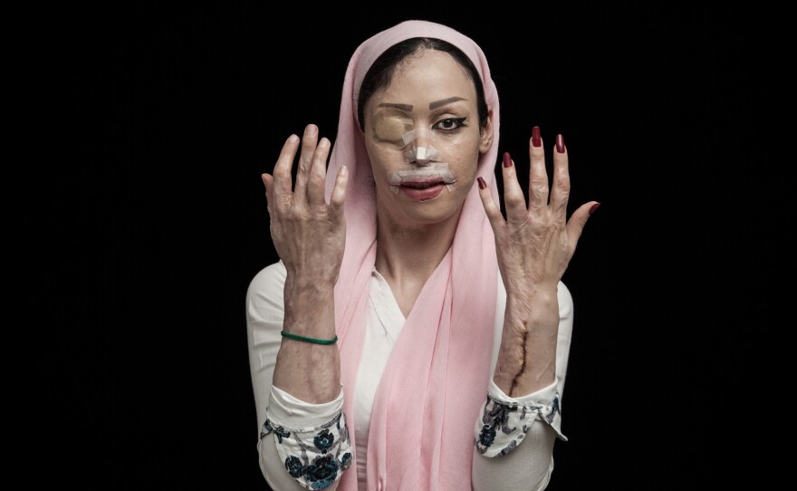 A woman in Iran shows her injuries from an acid attack. This victims of this kind of violence are often women and children. The trigger may be a family conflict, a rejected marriage proposal or a desire for revenge.