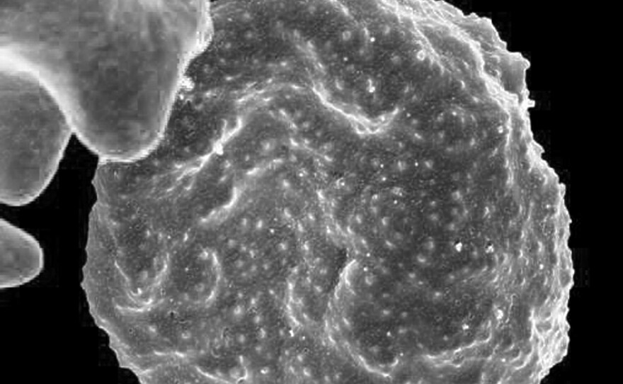 An electron microscope image of an infected red blood cell. The malaria parasite causes protrusions called "knobs" to form on the surface of the cell