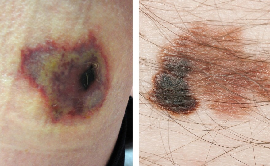 A recluse spider bite (left) can be confused with skin cancer.