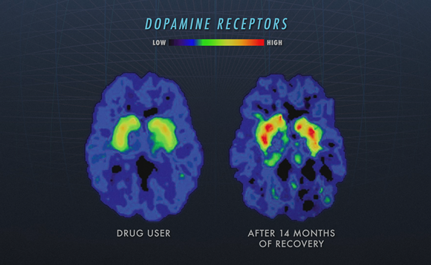 Graphic shows dopamine levels in a brain of a drug user next to one after 14 months of recovery.