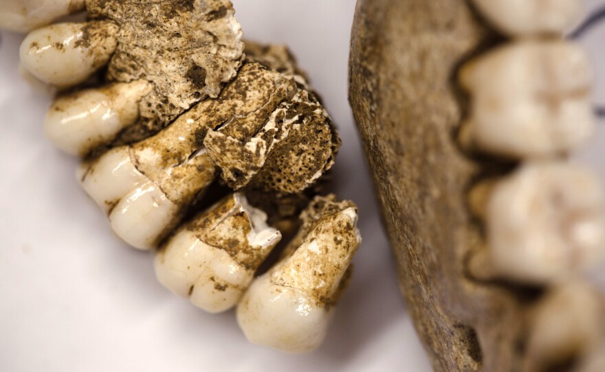 Owsley says the teeth of the skeletons show signs of tooth decay that would have been painful when the men were alive.