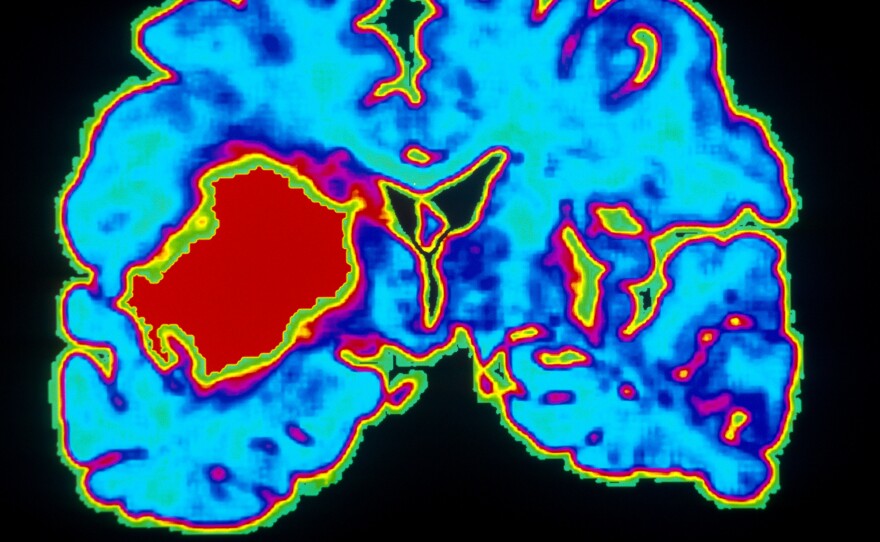 A computer-enhanced scan of a brain shows a hemorrhage due to hypertension.