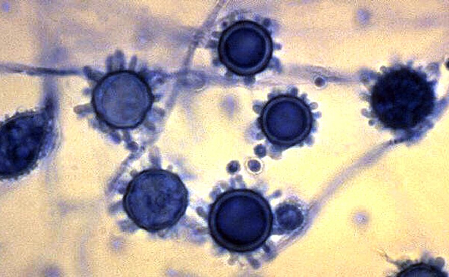 Cough? Check. Fever? Check. But bet you didn't think that this common fungus, Histoplasma capsulatum, could be making you sick.