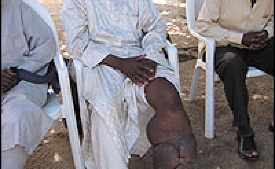 Hamisu Isa, 35, was at first devastated when he contracted lymphatic filariasis. It's still difficult for him to walk around, but he is getting his life back together. He has gone back to work selling used clothing in the marketplace and has signed up to get a teaching certificate. He also recently became engaged.