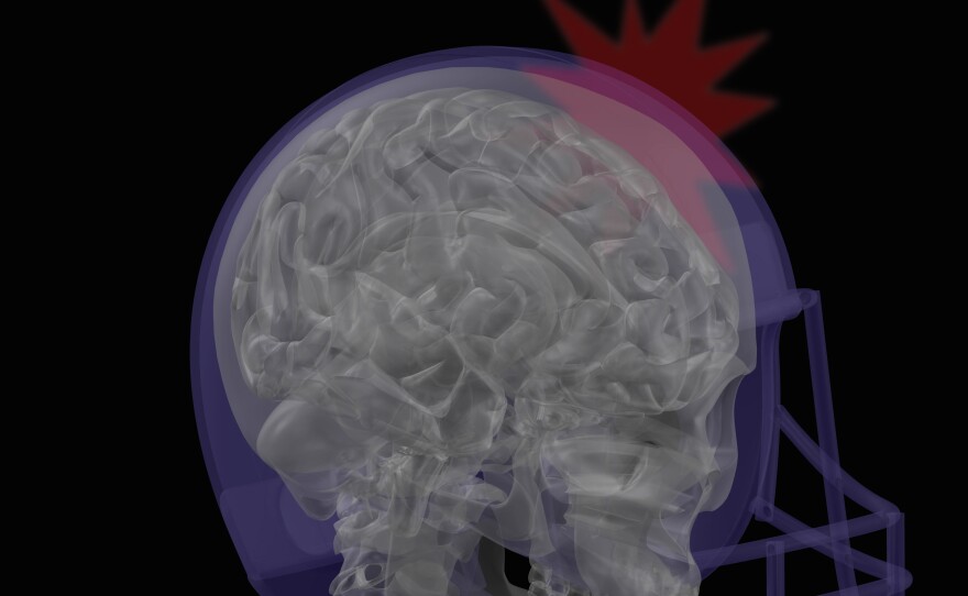 Researchers are studying athletes and military personnel to learn more about how a concussion can affect the brain's ability to understand sound.