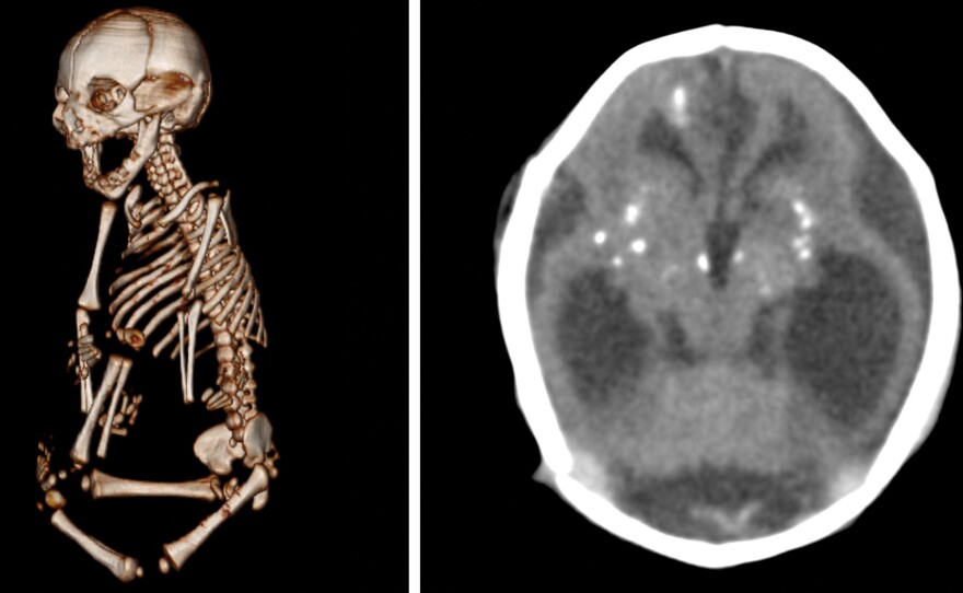 Zika infections during gestation can damage other parts of the body besides the brain. In this case, the baby was born with severe stiffness in the joints, which keeps the baby from straightening arms and legs normally. The baby's brain shows the telltale sign of an infection: white dots called calcification.