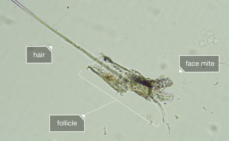 Since face mites live inside your pores, you can't wash them off. But for a majority of people, they're harmless.