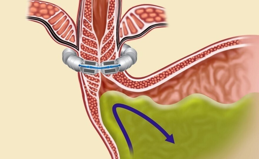 The LINX device cinches the lower esophagus to help keep stomach acid from moving upward.