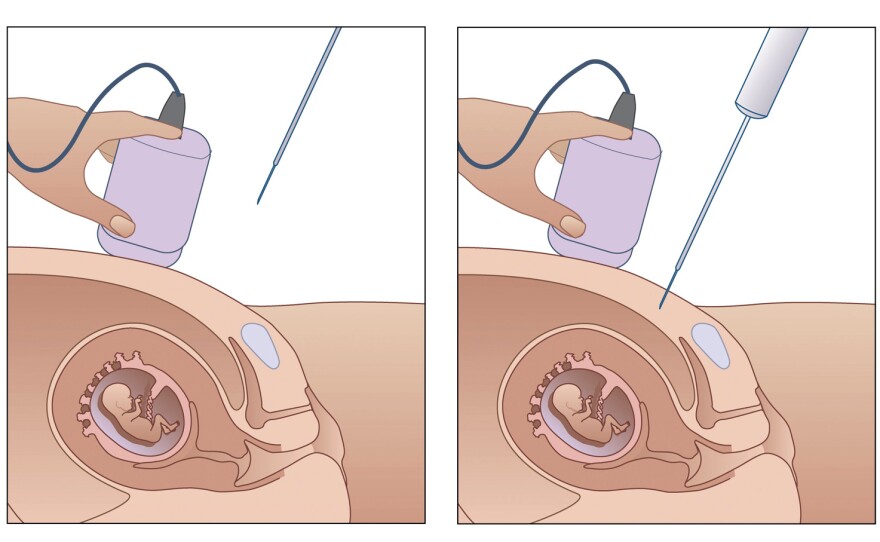 During amniocentesis, a needle is inserted through a woman's abdomen into the amniotic sac. A sample of fluid is extracted and screened for genetic disorders such as Down syndrome.